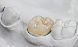Dental overlay on a tooth model.