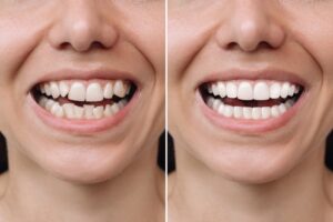 Before and after comparison of a woman's smile with and without veneers.
