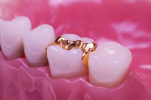 Tooth with a gold dental inlay.