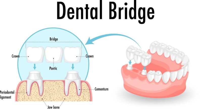 A dental bridge showing crowns, pontic, periodontal ligament, cementum, and jawbone