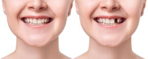 Comparison of a woman's smile before and after dental restoration to fill missing teeth.