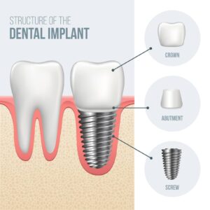 Diagram showing the structure of a dental implant next to a natural tooth.